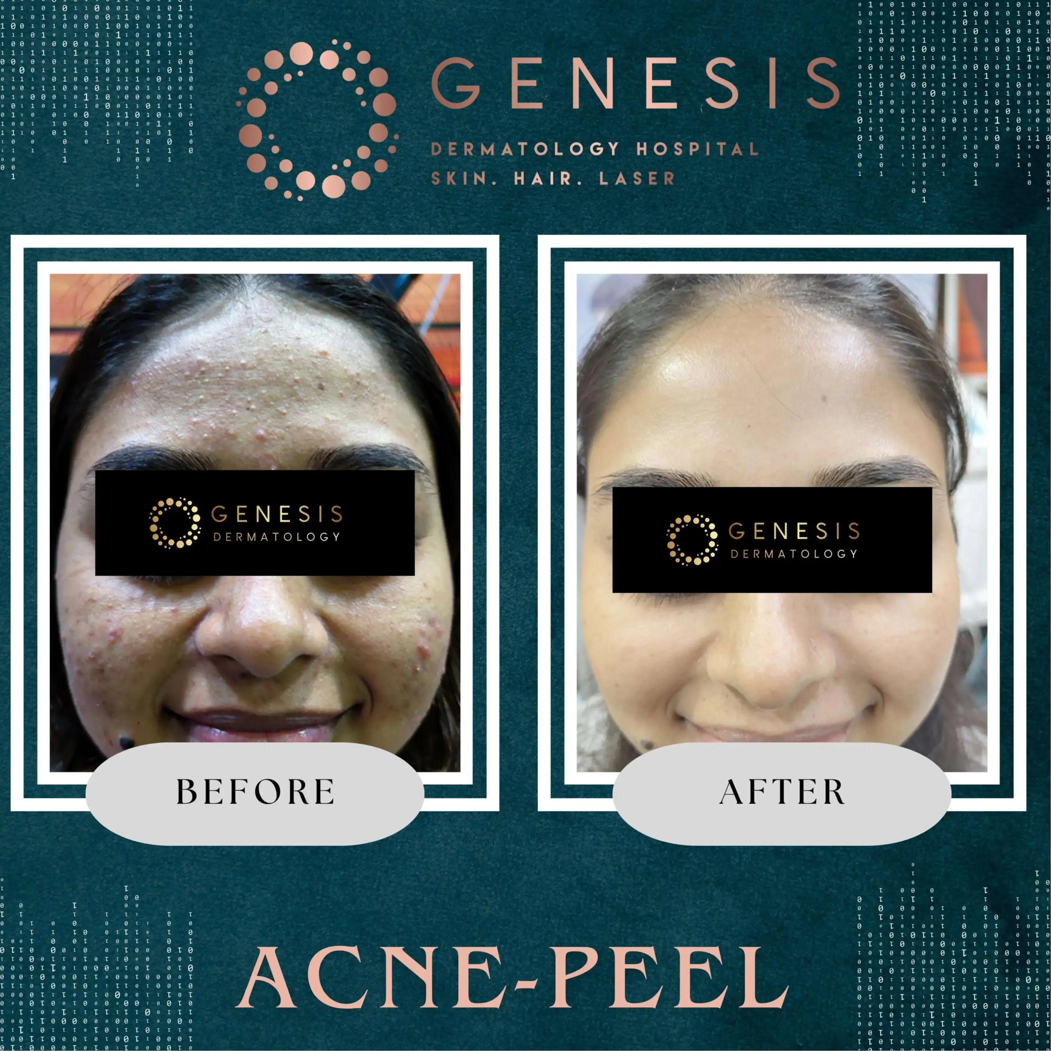 Pimple Treatment