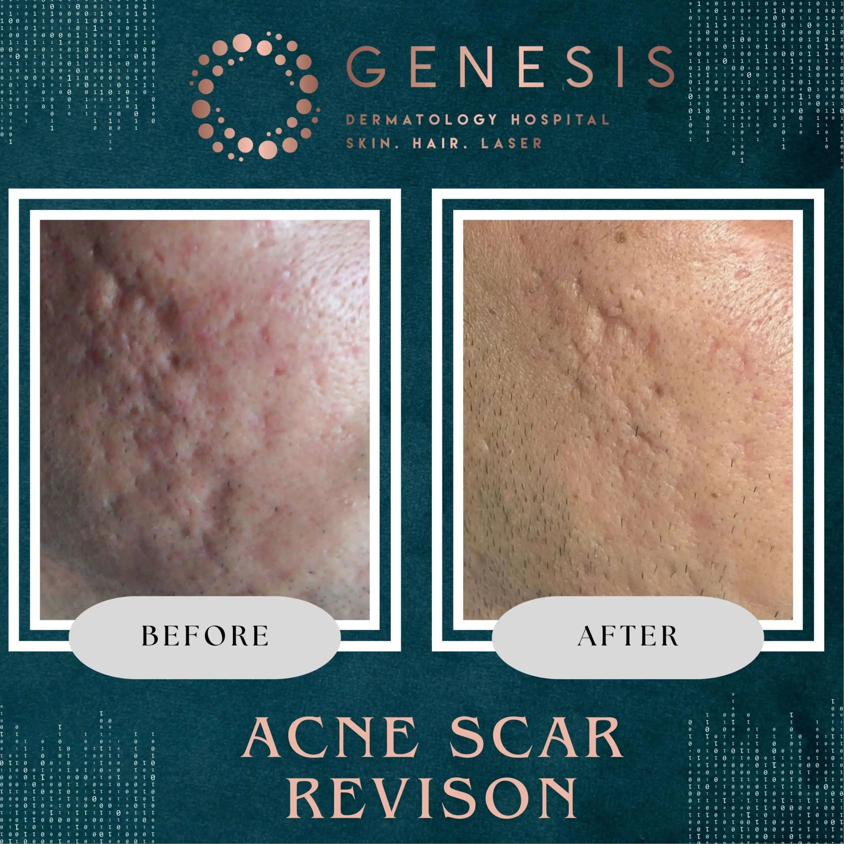 Acne/ Scar