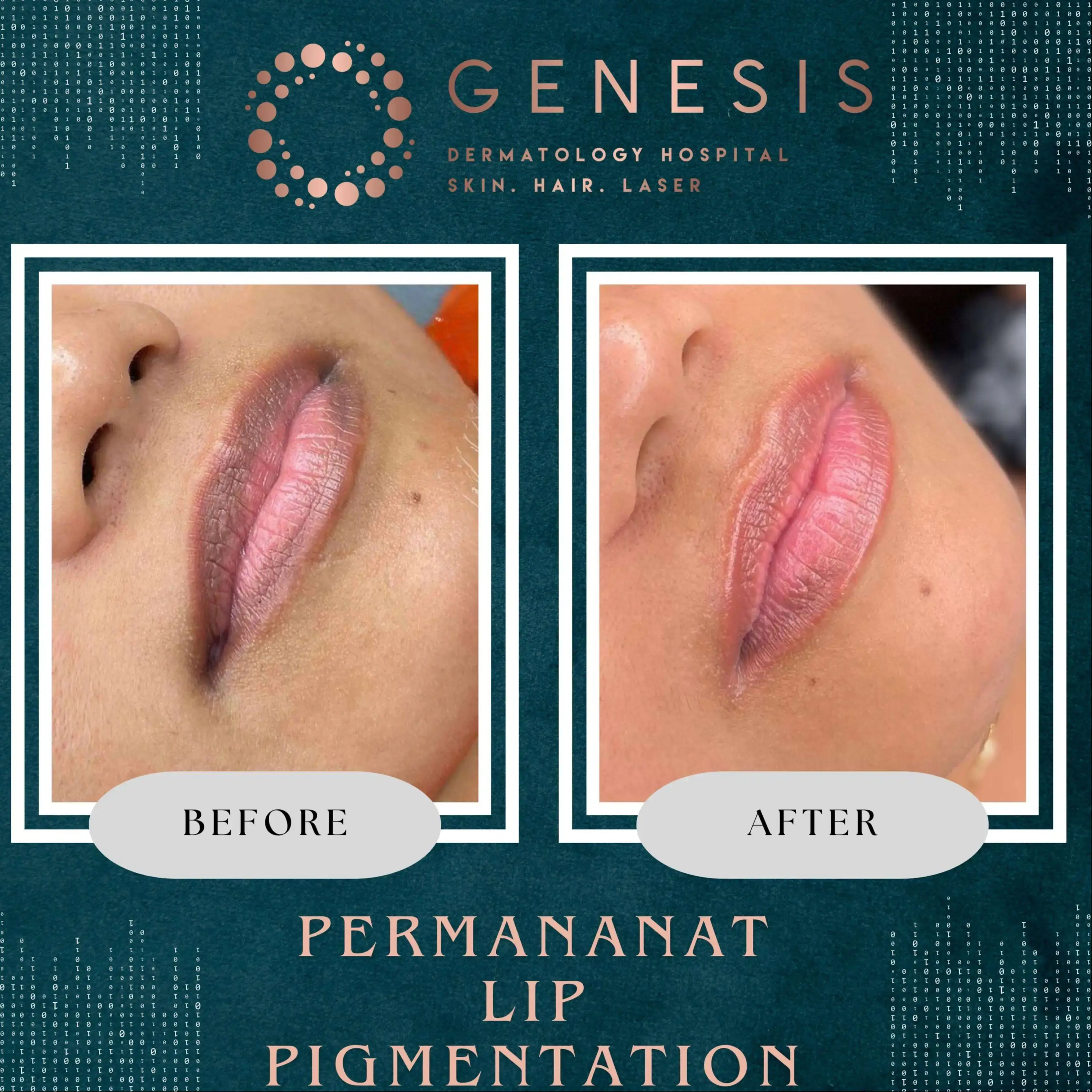 PRP Hair Treatment