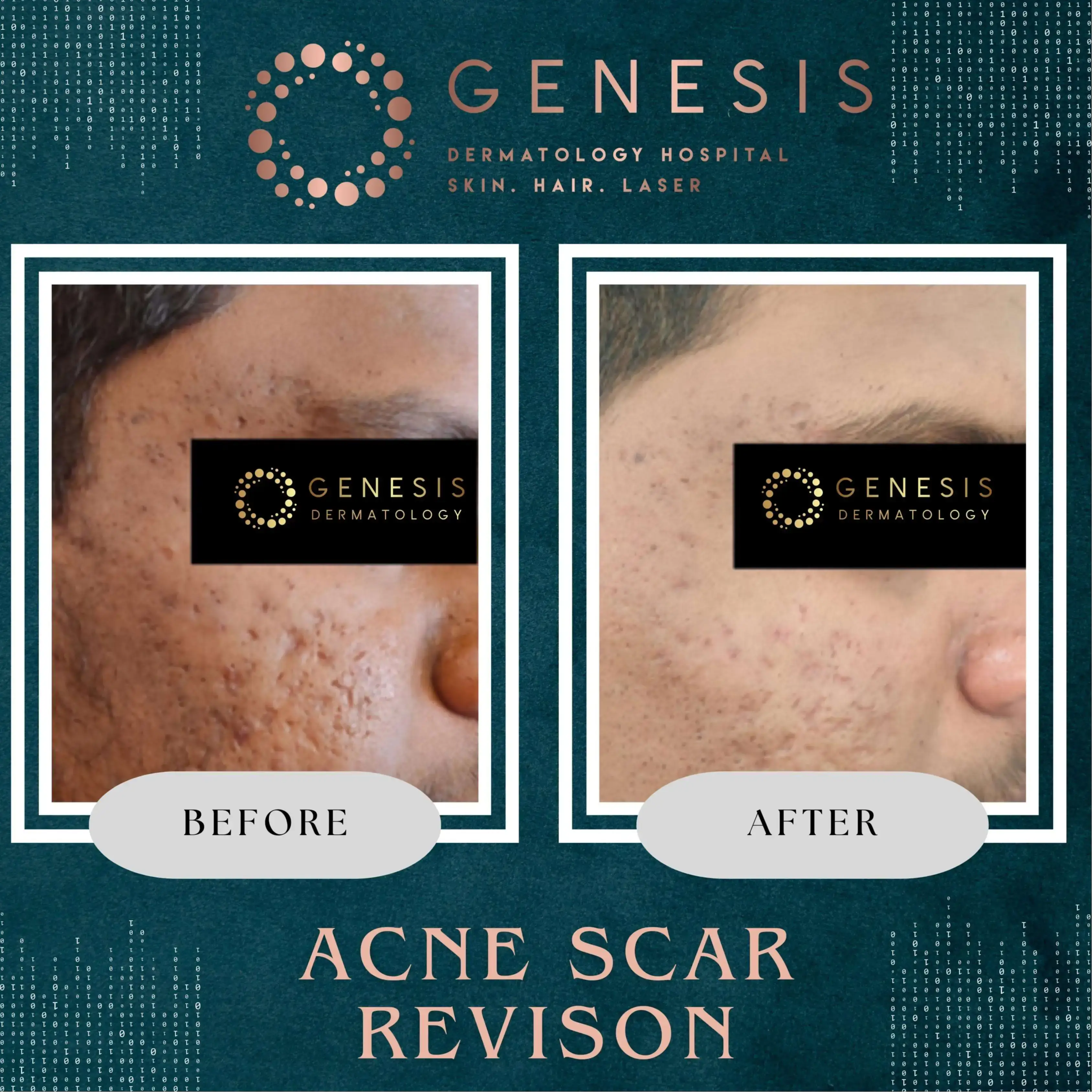 PRP Hair Treatment