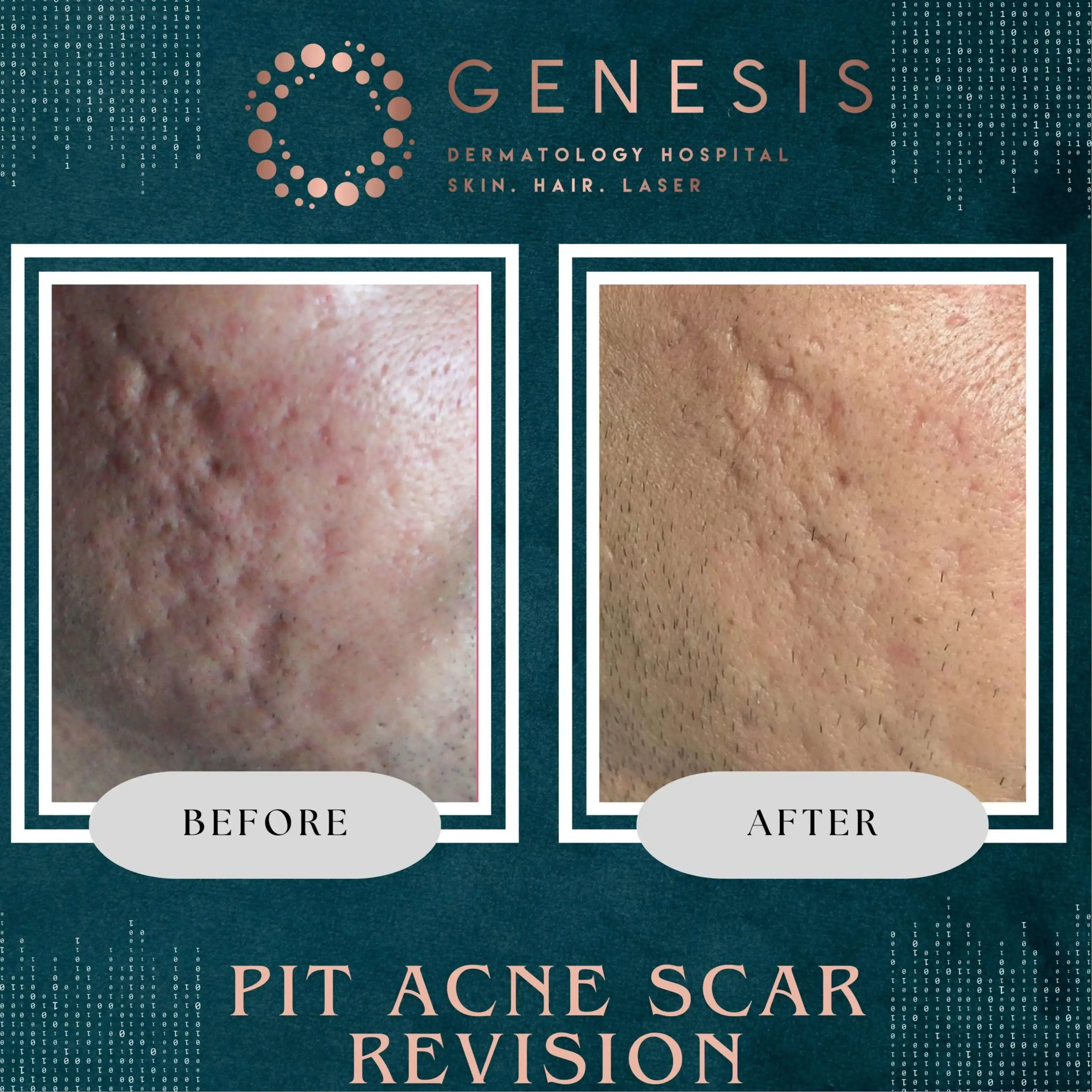 PRP Hair Treatment