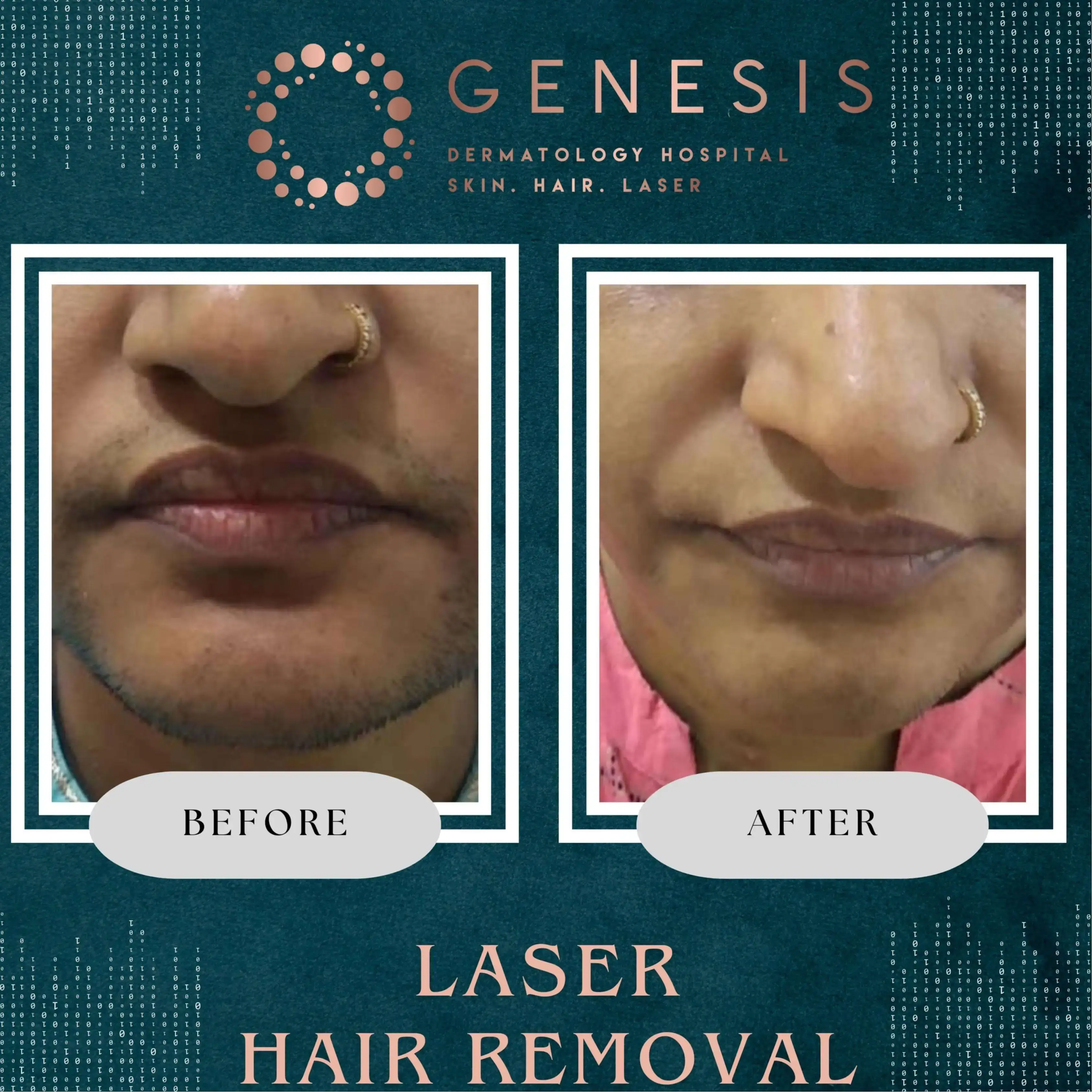 PRP Hair Treatment