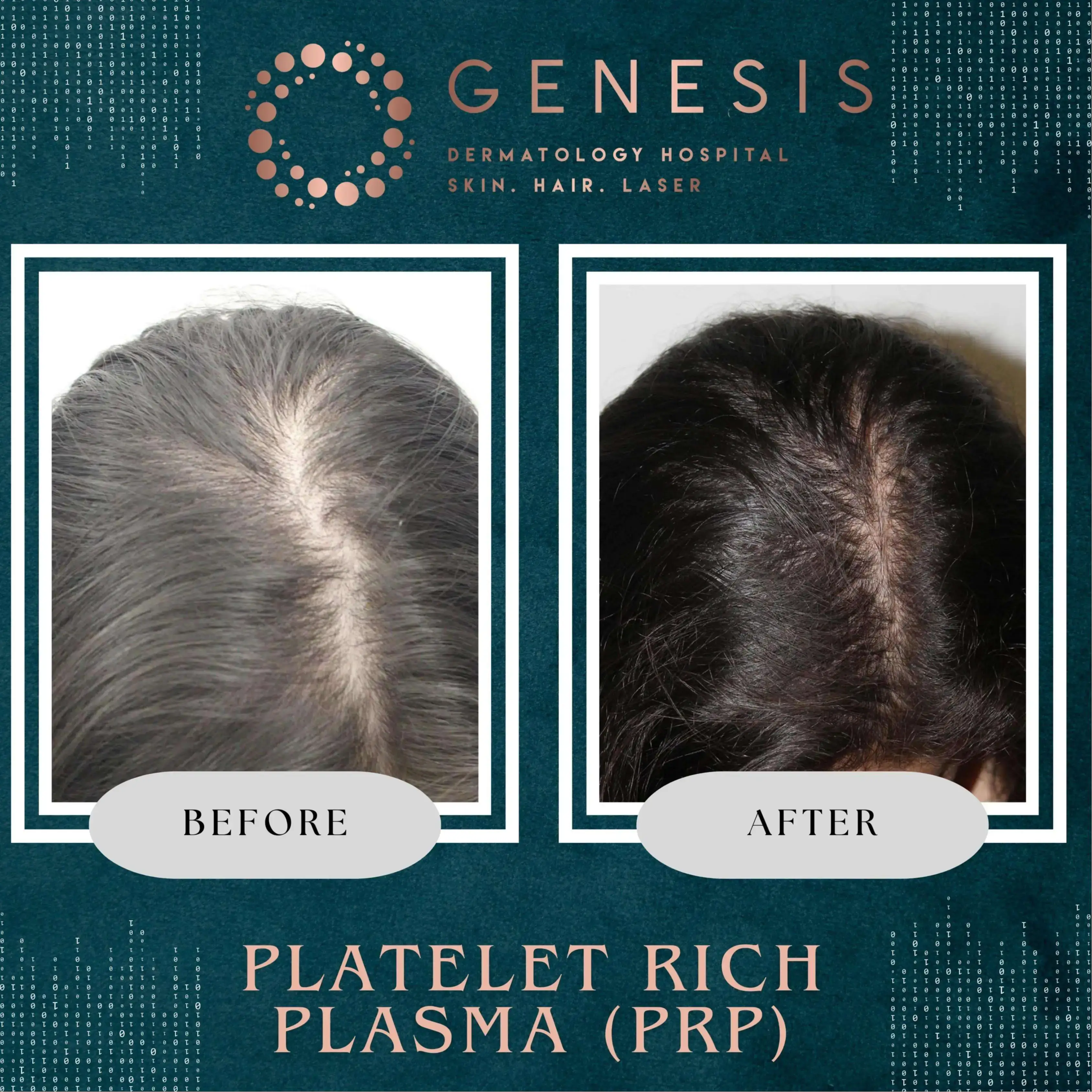 PRP Hair Treatment