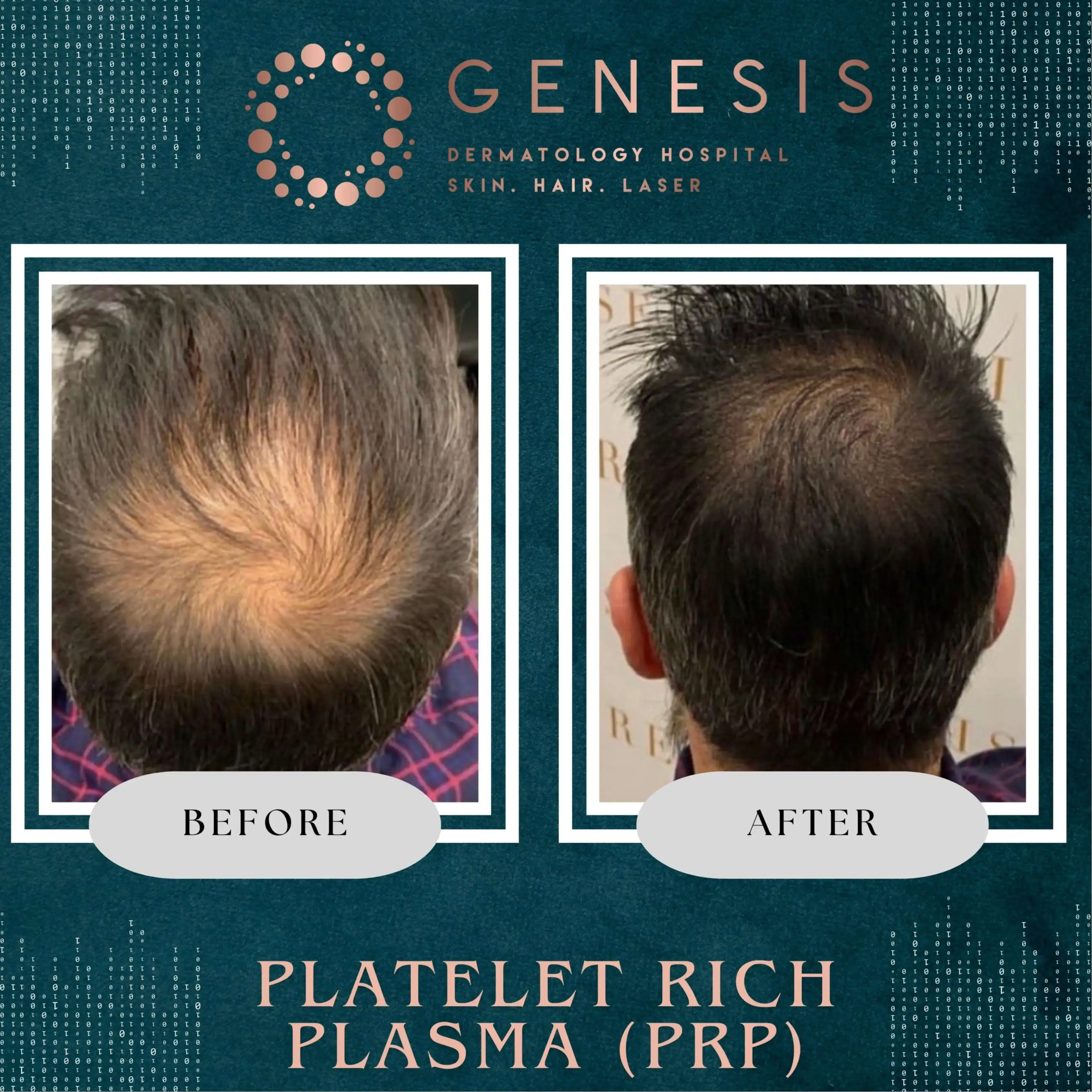 PRP Hair Treatment