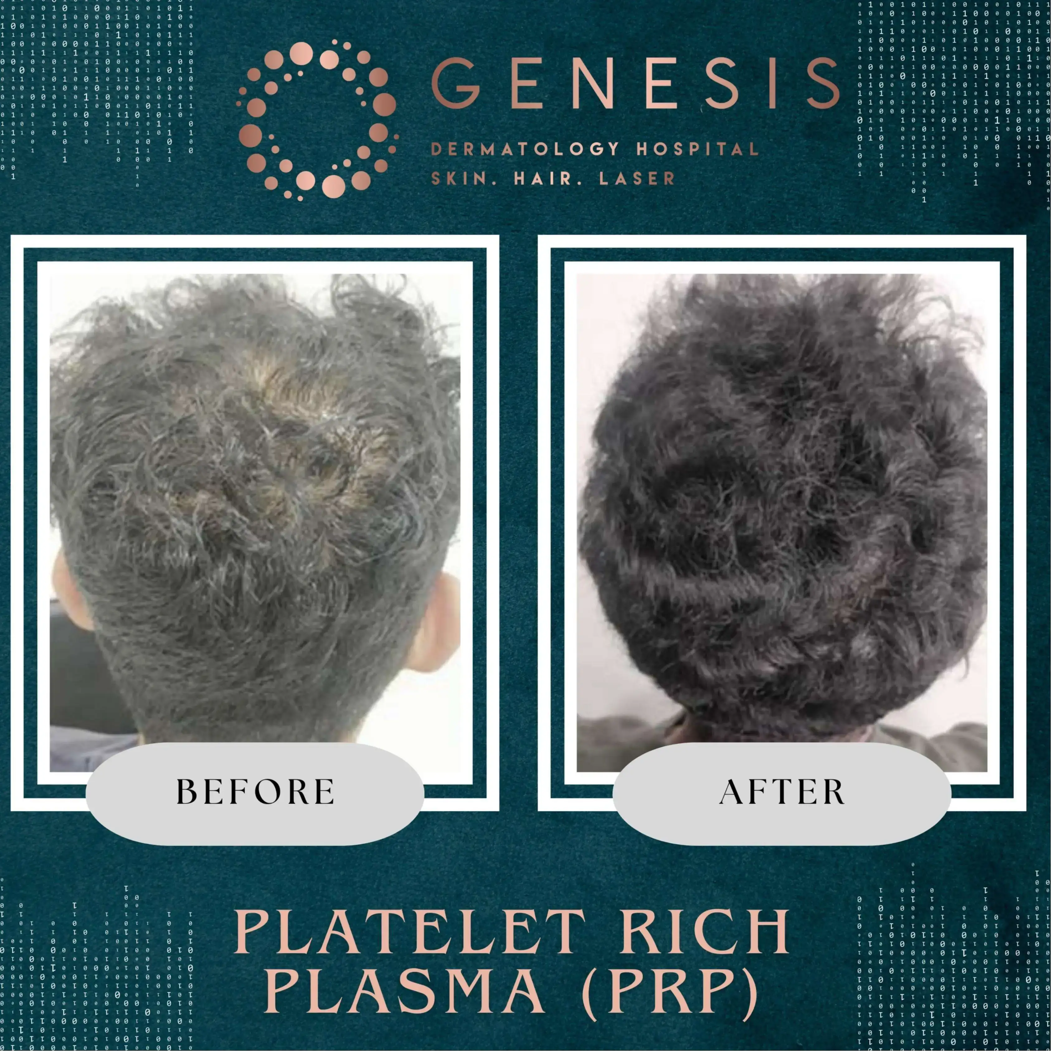 PRP Hair Treatment