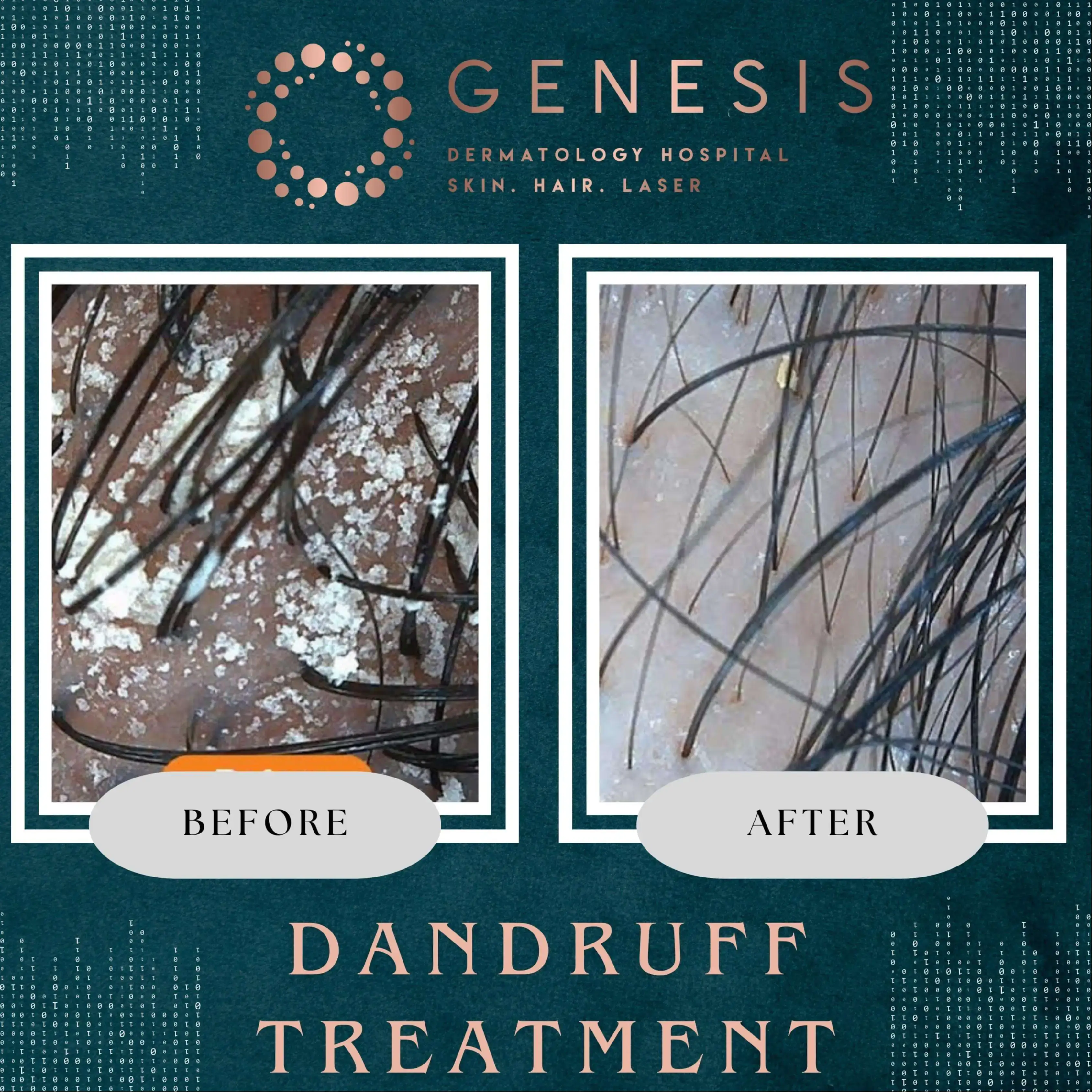 PRP Hair Treatment