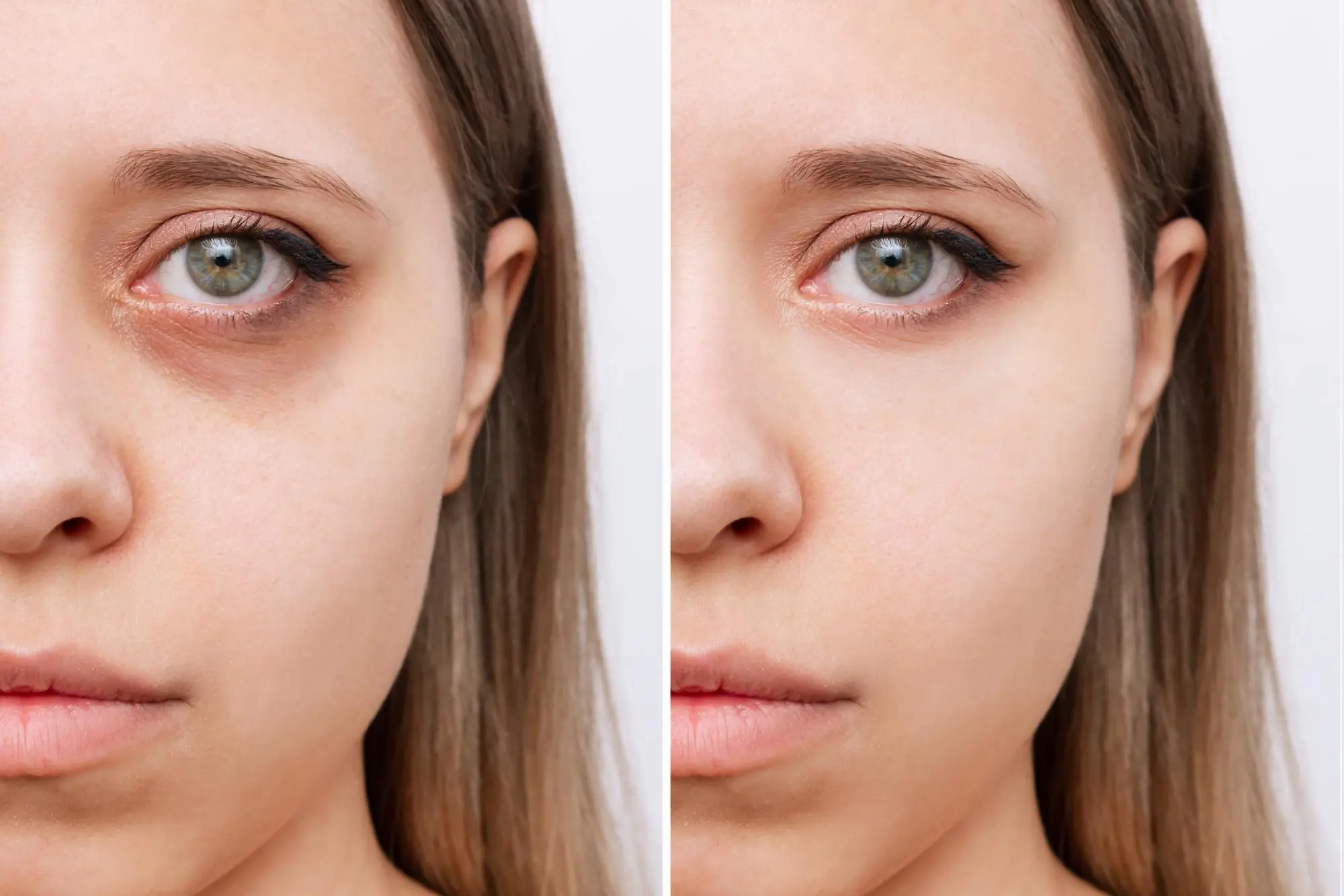 Dark Circle Treatment