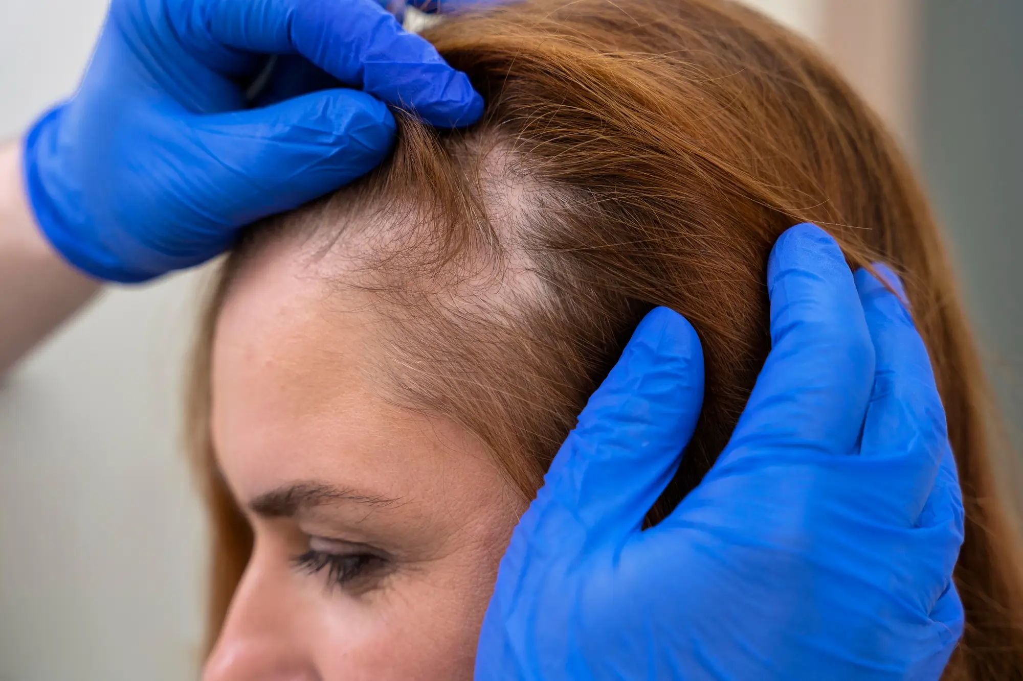 Hair Loss Treatment