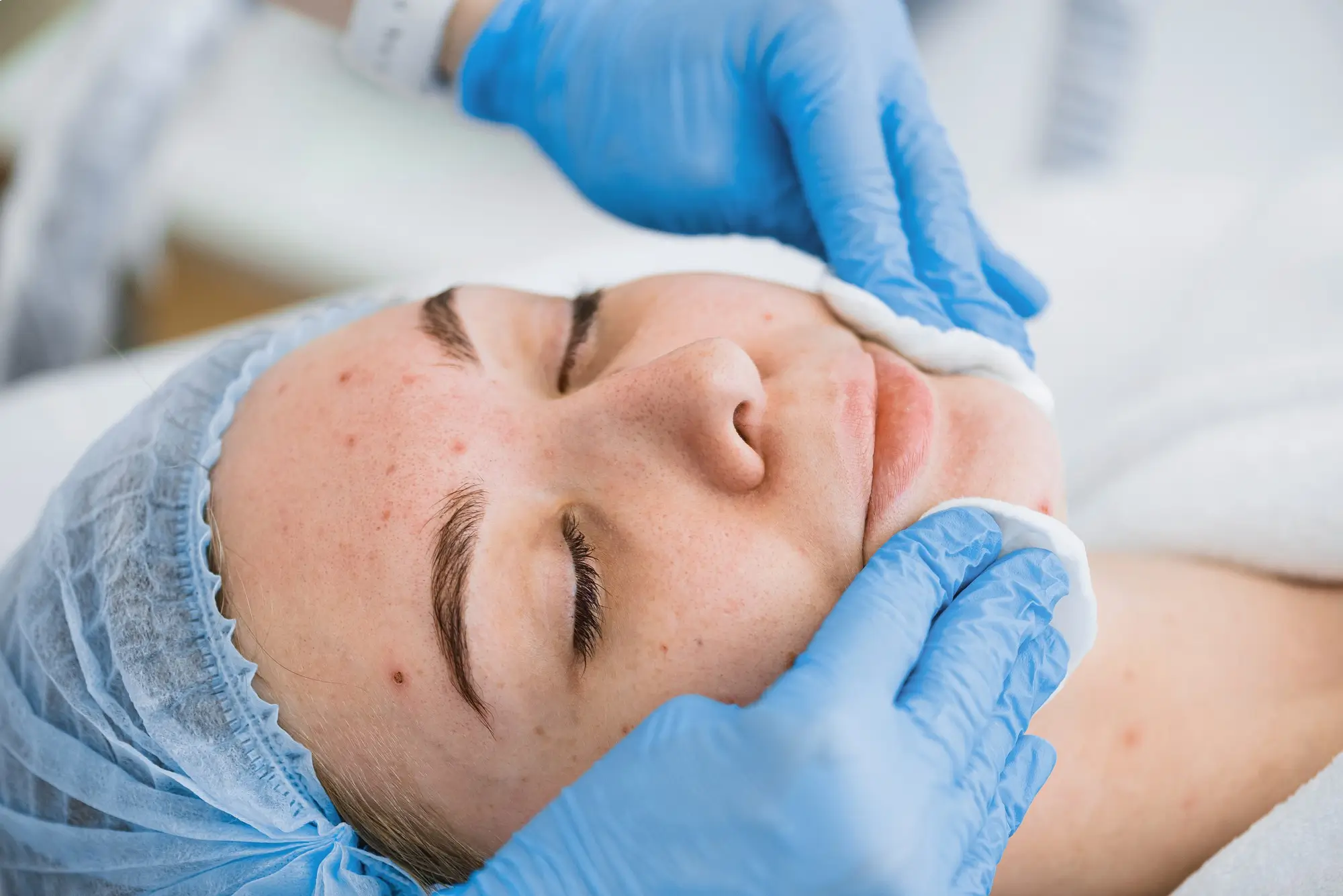 Pigmentation Treatments