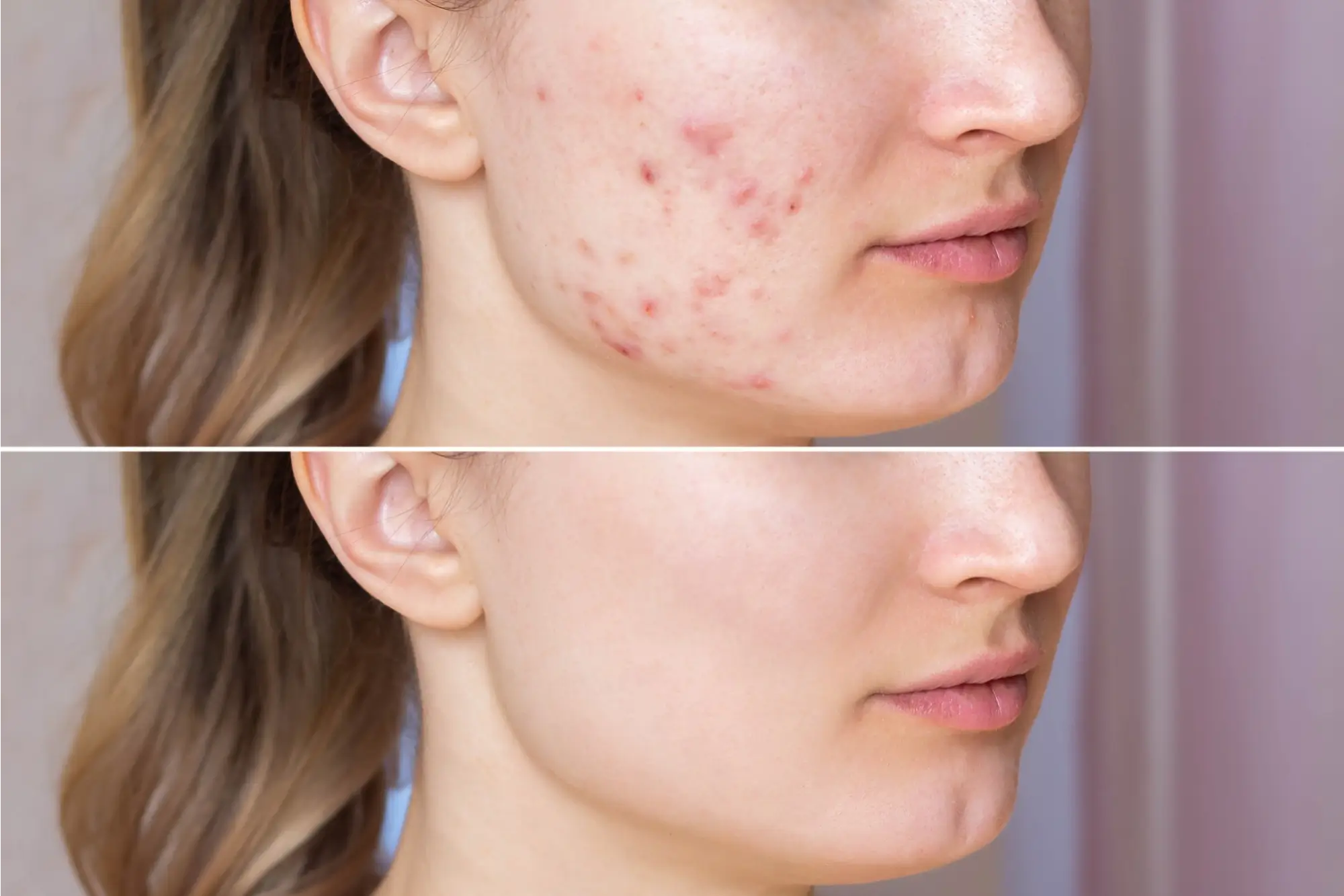 Pimple Treatment