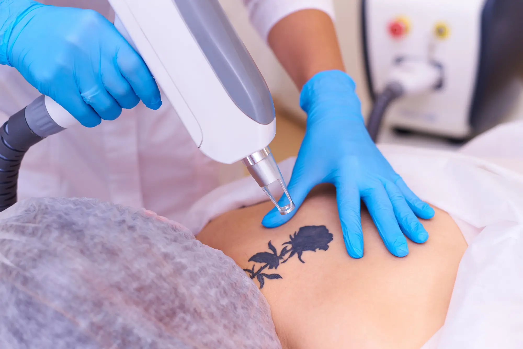 Tattoo Removal Treatment