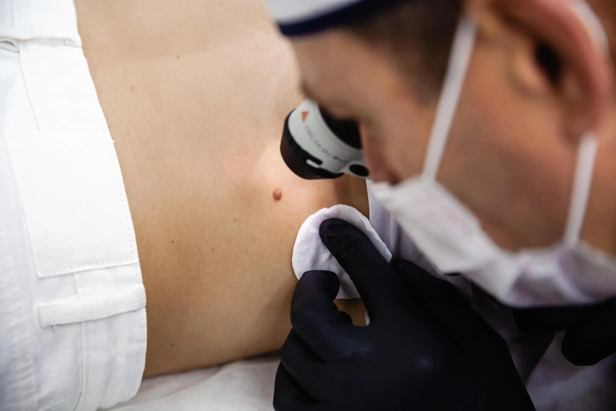 Warts Removal Treatment